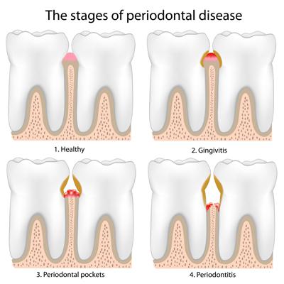 Treatment for periodontal gum disease in Blue Bell, PA