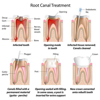 Root canal therapy and treatment in Blue Bell, PA